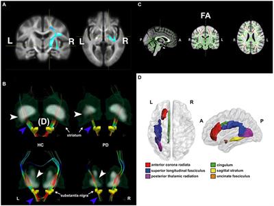 Recent advances in using diffusion tensor imaging to study white matter alterations in Parkinson’s disease: A mini review